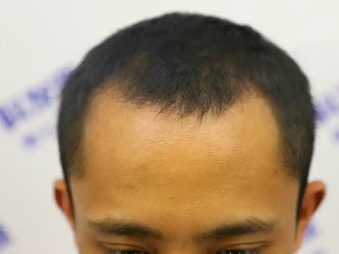 秃秃的鬓角真的很显老,从我的经历来看深有体会,植发_圈子-新氧美容