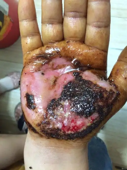 右手掌被机器滚轴压伤兼烫伤