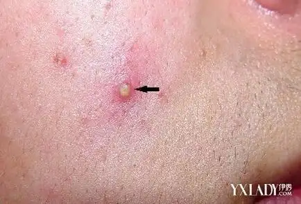 【图】三张图告诉你什么叫白头粉刺 四个小建议让你轻松处理粉刺