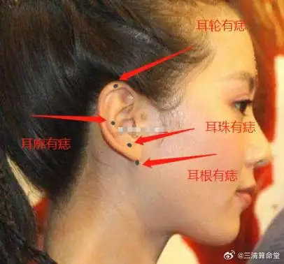 耳朵上各个位置的痣都有不同的寓意,你们知道吗?1,耳珠有痣主财.