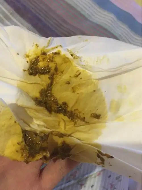 三天拉绿色粘稠胎便,之后便便一直都是这样带有颗粒状的东西,水便分离