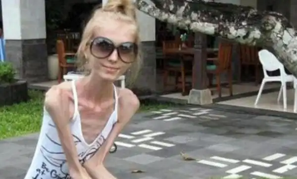 瘦成干尸的少女俄罗斯少女因厌食症仅为20公斤