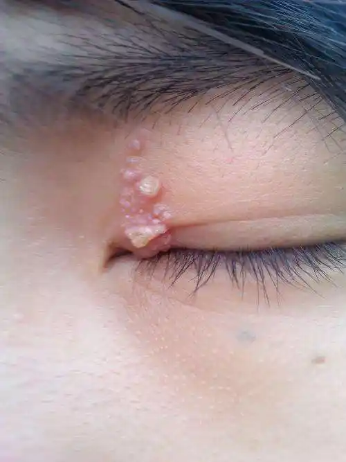 眼皮上脂肪粒自行脱落,眼角的脂肪粒怎么去除小窍门