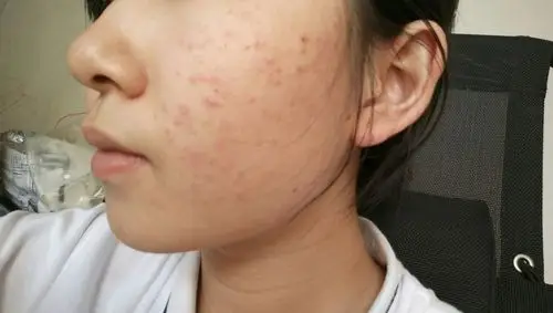 大家帮我看一下皮肤这是痘痘还是什么 要怎么解决?