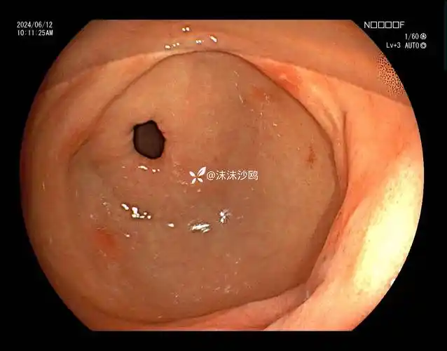 经久难愈的胃溃疡