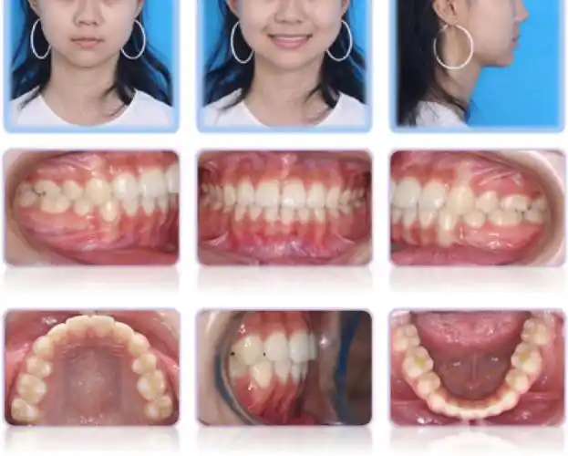 小姑娘双牙弓前凸,矫正后青春少女