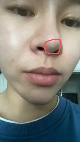 膨体夹耳软骨隆鼻半年发现鼻头有一个小突起不疼不痒会不会串出来