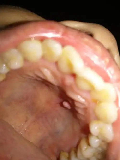 请问口腔上面长一个肉疙瘩出来是什么问题?