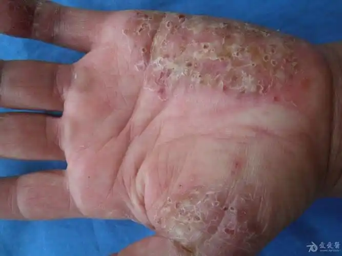 掌跖脓疱病.