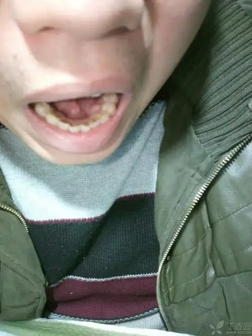 牙龈上长个肿块,求教这个是什么导致的