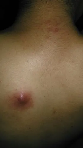 背上起了个小红疙瘩,挤了以后出血水,过了几天变