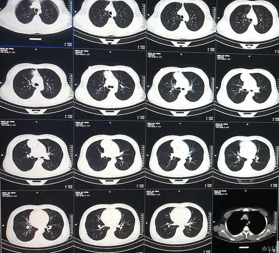 女性,无任何自觉症状,体检肺ct平扫 增强