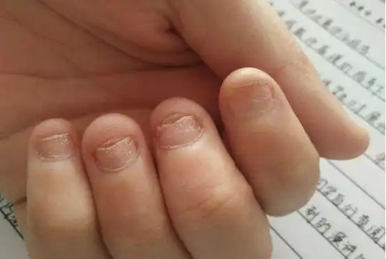 长时间咬手指甲怎么办,怎样才能预防咬指甲?