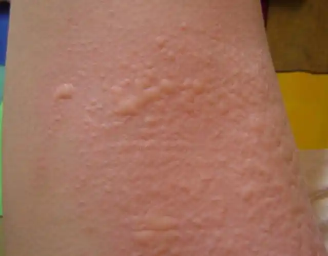 慢性荨麻疹复发了,你要知道如何治