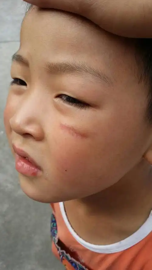 请问我6岁半的儿子脸上有块疤痕在幼儿园被小朋友撞到的,疤痕长度为