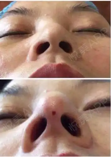 线雕隆鼻有什么危害吗为什么线雕隆鼻在国外被禁止线雕隆鼻有什么危害