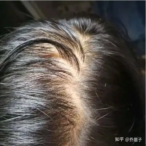 女生秃顶是怎样一种体验?