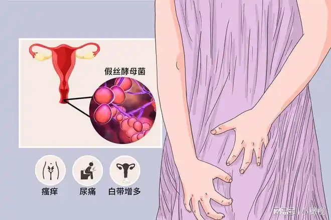 天气炎热孕妈如何远离这种高发的妇科病