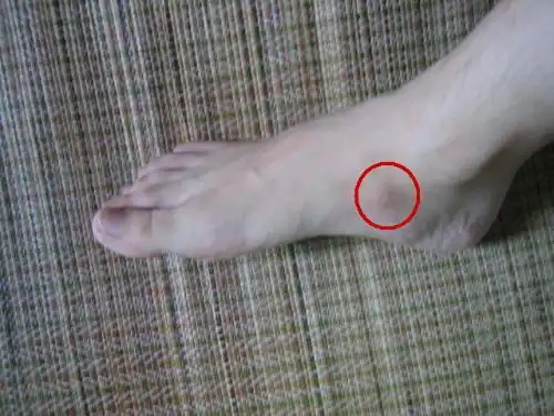 骨头突起差不多6  7年了.