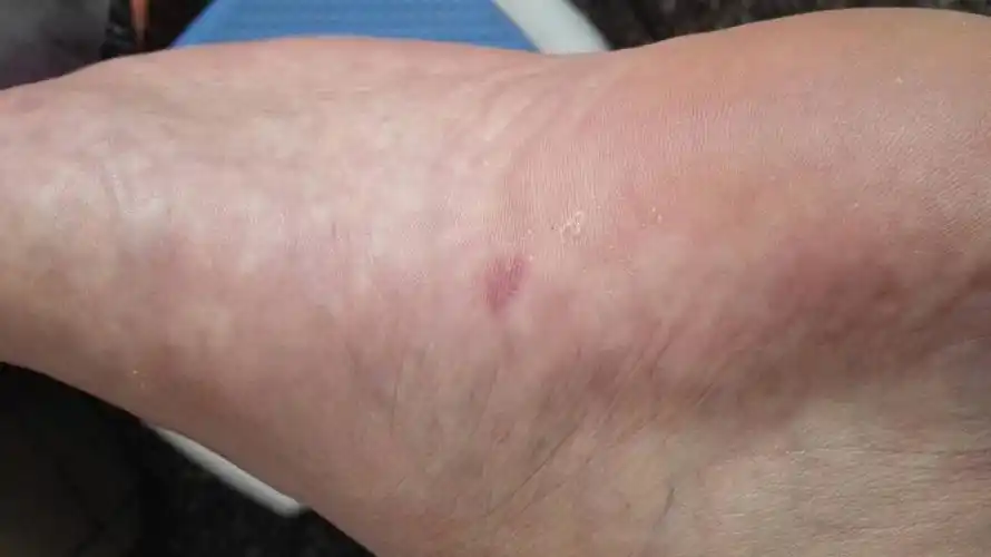 今天去修脚,修脚师傅问这个红斑疼不疼,说有可能是血管瘤,我这个足弓