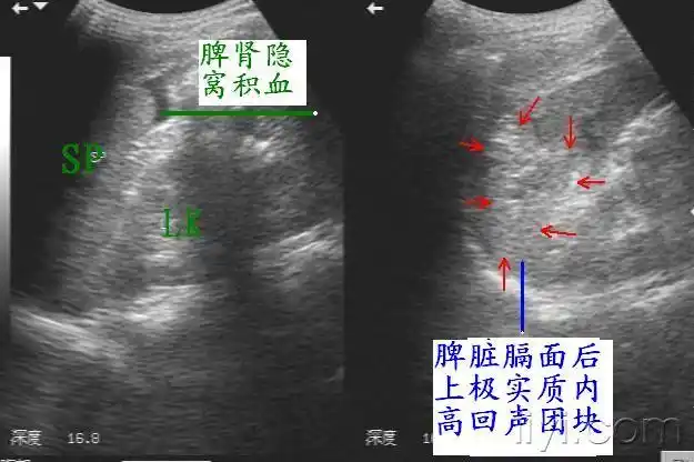 迟发性脾破裂(10月4日更正) - 超声医学讨论版 - 爱爱医医学论坛