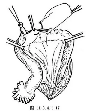 腹部输卵管结扎术