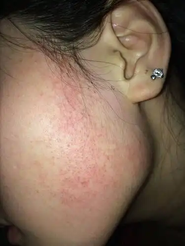 大家帮帮我吧,这是毛周角症吗 ?用什么产品可以去除呢?