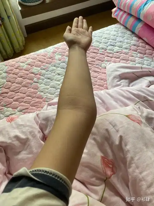 肘外翻是一种怎样的体验如图