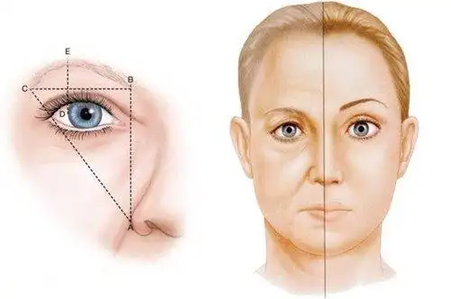 眼尾下垂怎么办?