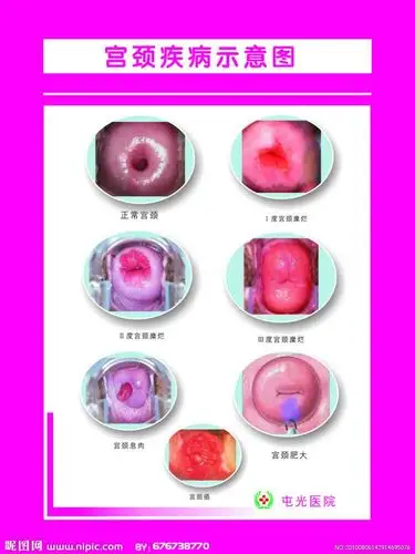 宫颈症状