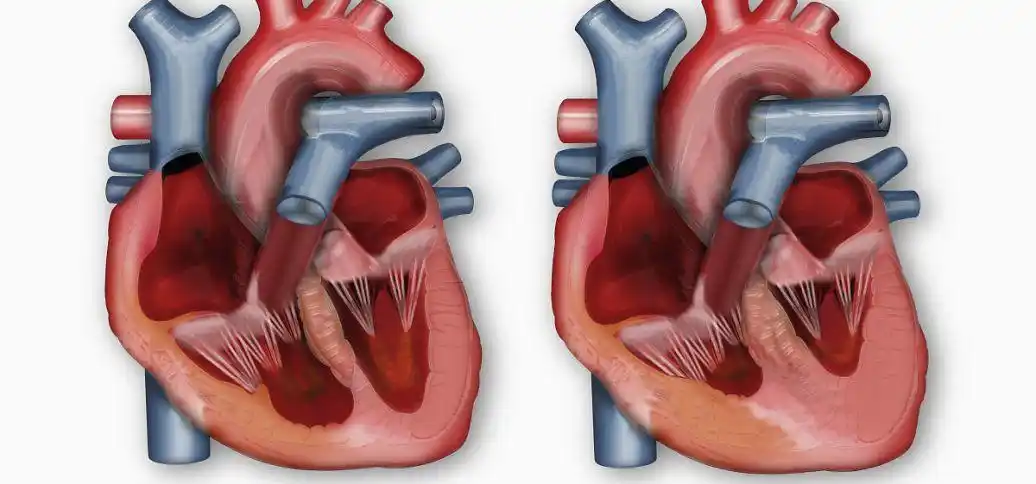 心脏二尖瓣病变及其中医调治办法
