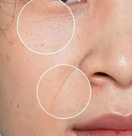 t区油和眼部有细纹怎么处理?插图