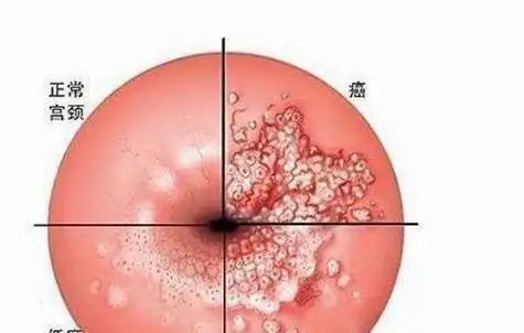 宫颈癌的早期症状及表现有哪些