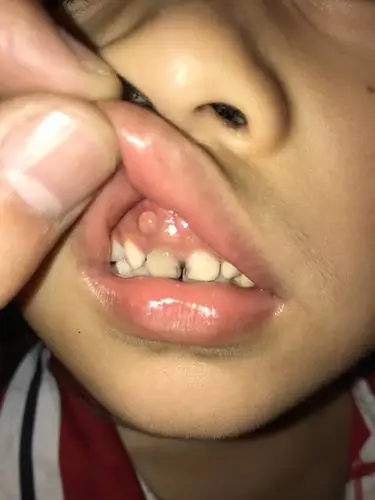 懂医疗的进来看看,小孩子上嘴唇里面长了一个黄豆大小的肉肉
