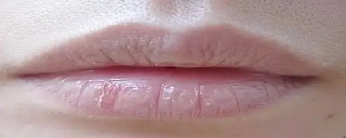 覆口唇是属于什么嘴唇