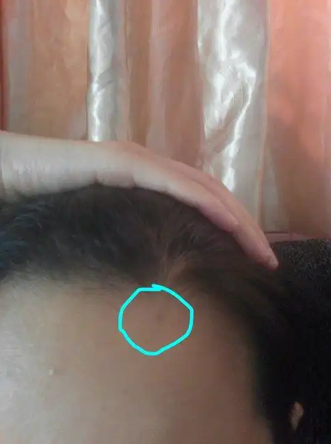 左侧额头发际线处长痣好不好?能点掉吗?