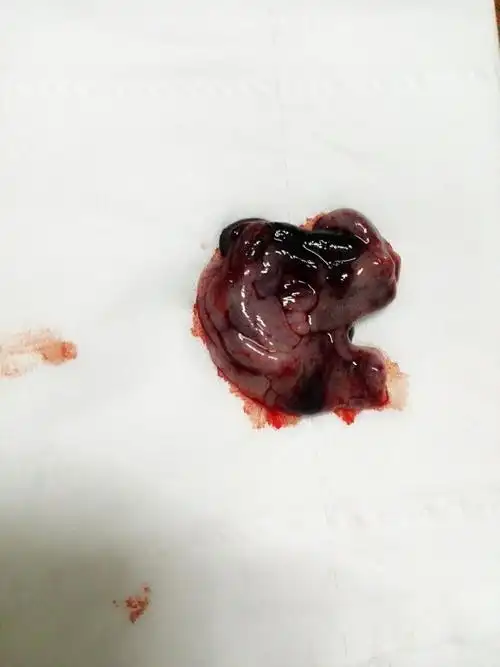 孕早期30天自然流产,三天后傍晚肚子闷闷的疼,排出