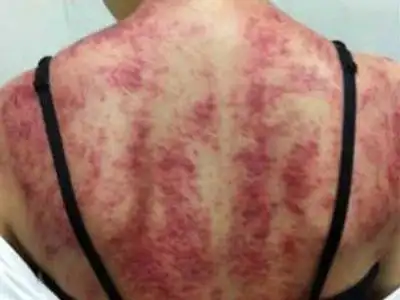 刮痧不出痧 背后原因是气血不足