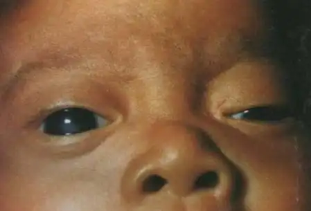 神经纤维瘤病图片(图谱)概述