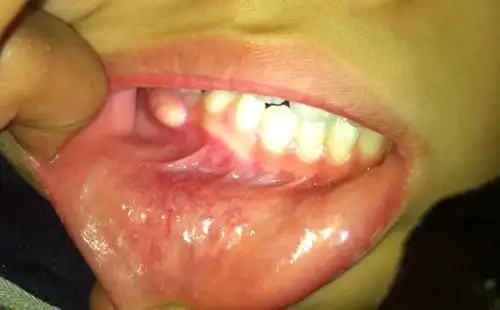 八岁小孩牙龈上长了个很大的脓包,孩子说不疼不痒,按压的话有点疼,请