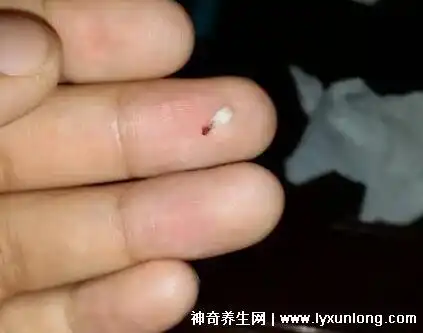 鸡眼挖出来的根图片,白色米粒大小的肉刺(没挖干净会复发) — 神奇