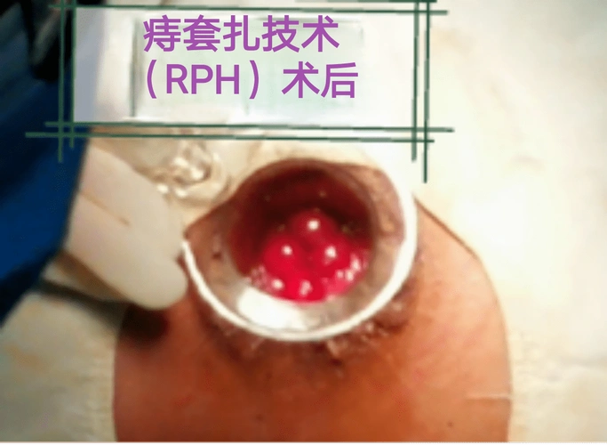 痔疮术后健康宣教