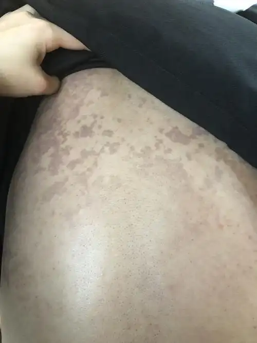 后背上这段时间长黑斑