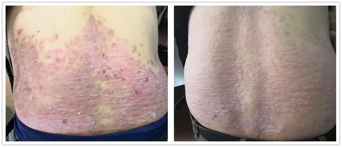 中医中药治疗在银屑病(牛皮癣)治疗上的临床案例_银屑病_中医疗法