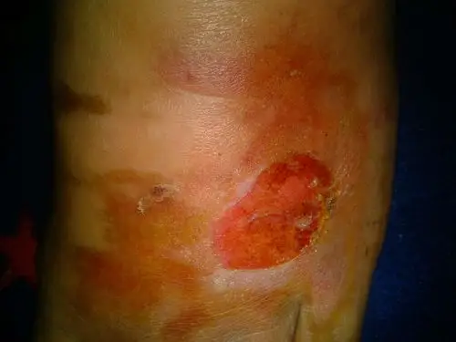 脚被烫伤,48小时后疼痛减轻,现在又疼是怎么回事?