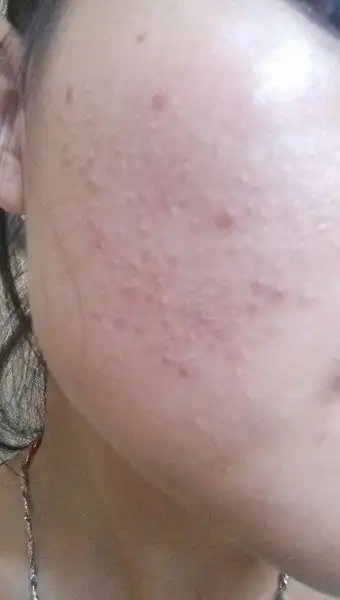 闭口粉刺怎么办?