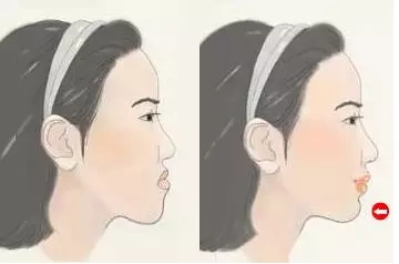 地包天:上颌后缩下颌前突,即下面的牙齿咬合在上面牙齿的外部