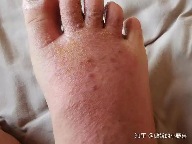 我又得湿疹了还是脚背的还夹杂着脚气