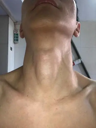 这个喉结正常吗