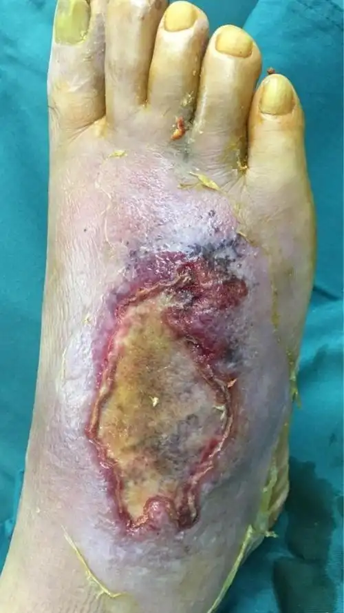 糖尿病足背皮肤软组织感染扩创vsd后,肉芽创面二期植皮修复手术前后